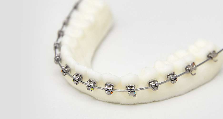 커스텀 교정치료