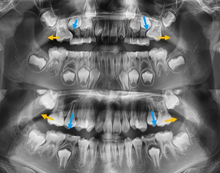 어린이 예방교정