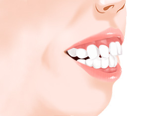 돌출 + 잇몸 노출