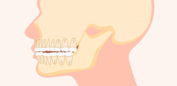 턱뼈에 비해 치아의 크기가 큰 경우