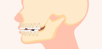 유치의 충치를 그대로 방치한 경우