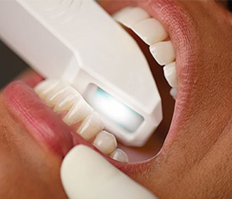 치아의 외형 스캔